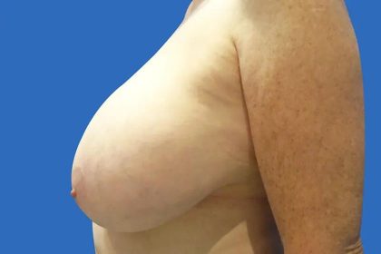Breast Lift Before & After Patient #21019