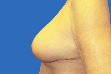 Breast Lift Before & After Patient #21019