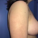 Breast Lift Before & After Patient #21020