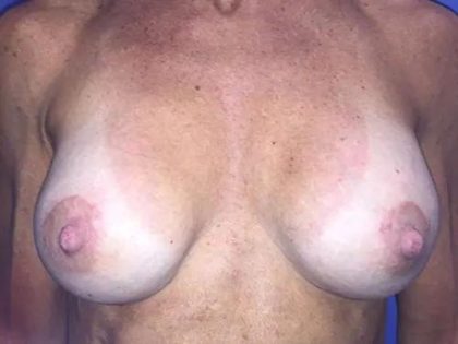 Breast Lift Before & After Patient #21023