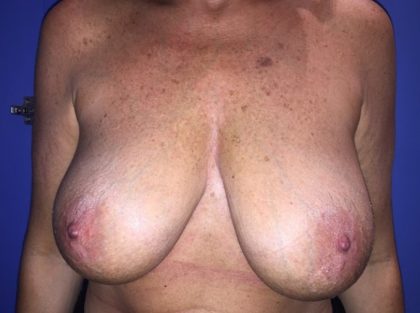 Breast Reduction Before & After Patient #21402