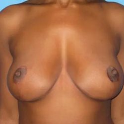 Breast Reduction Before & After Patient #21042