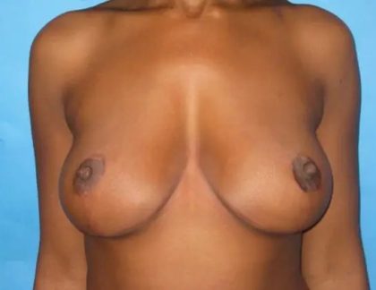 Breast Reduction Before & After Patient #21042