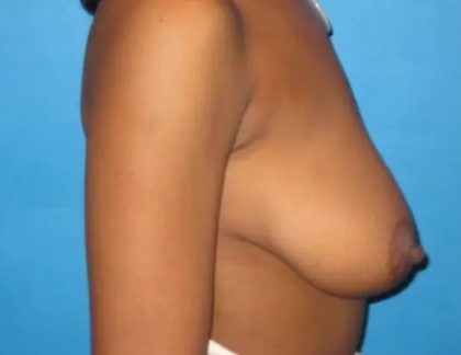 Breast Reduction Before & After Patient #21042