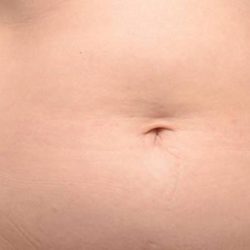 CoolSculpting Before & After Patient #21156