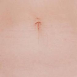 CoolSculpting Before & After Patient #21156