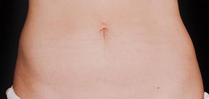 CoolSculpting Before & After Patient #21156