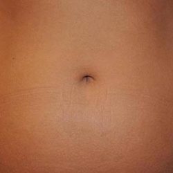 CoolSculpting Before & After Patient #21163