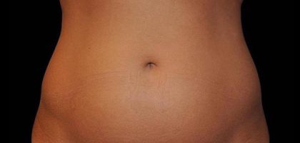 CoolSculpting Before & After Patient #21163