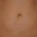 CoolSculpting Before & After Patient #21163