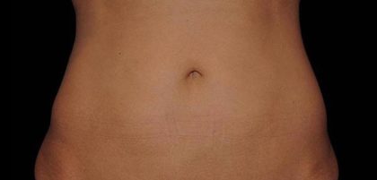 CoolSculpting Before & After Patient #21163