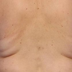 CoolSculpting Before & After Patient #21171