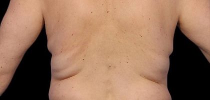 CoolSculpting Before & After Patient #21171