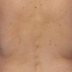 CoolSculpting Before & After Patient #21171