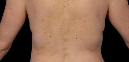 CoolSculpting Before & After Patient #21171