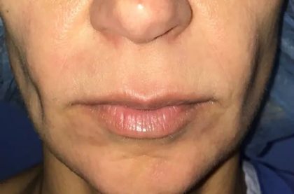 Chin Augmentation Before & After Patient #20911