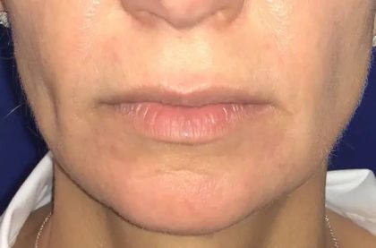 Chin Augmentation Before & After Patient #20911