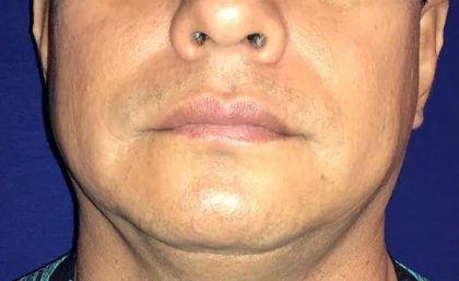 Chin Augmentation Before & After Patient #20944