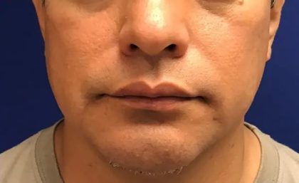 Chin Augmentation Before & After Patient #20944