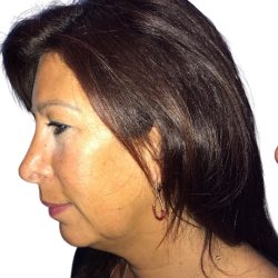 Chin Augmentation Before & After Patient #20945
