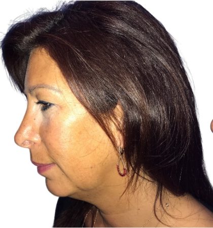 Chin Augmentation Before & After Patient #20945