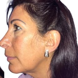 Chin Augmentation Before & After Patient #20945