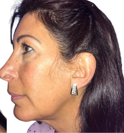 Chin Augmentation Before & After Patient #20945