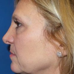 Facelift Before & After Patient #20946