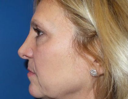 Facelift Before & After Patient #20946