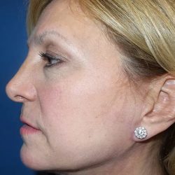 Facelift Before & After Patient #20946