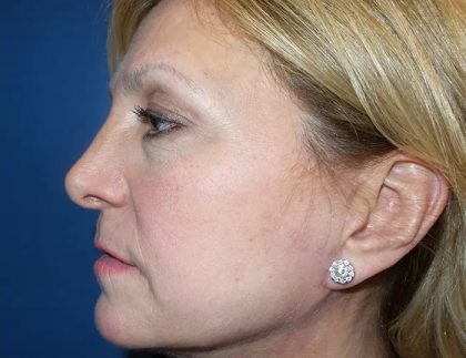 Facelift Before & After Patient #20946