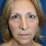 Facelift Before & After Patient #20946