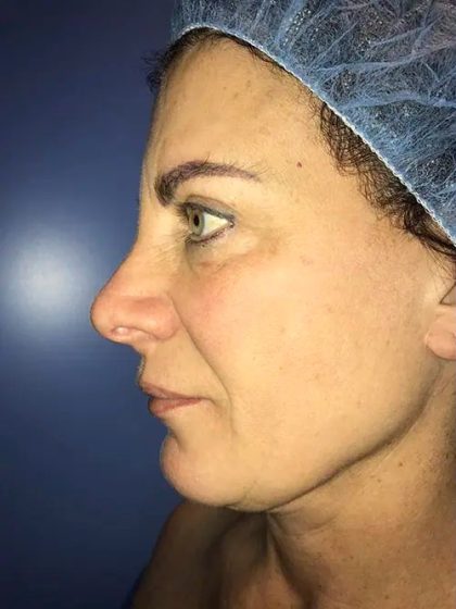 Facelift Before & After Patient #20991