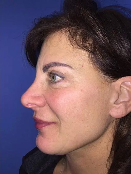 Facelift Before & After Patient #20991