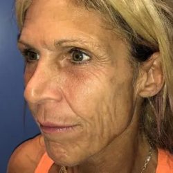 Facelift Before & After Patient #20948