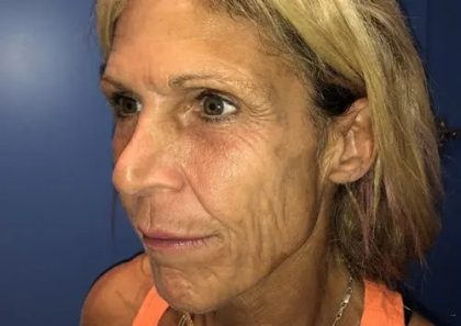 Facelift Before & After Patient #20948