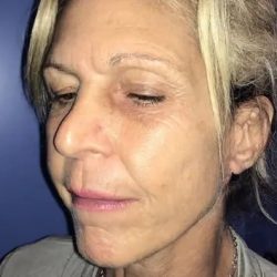 Facelift Before & After Patient #20948