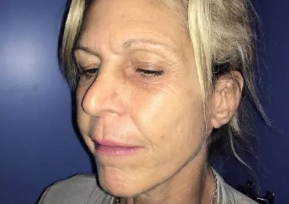 Facelift Before & After Patient #20948