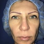 Facelift Before & After Patient #20949