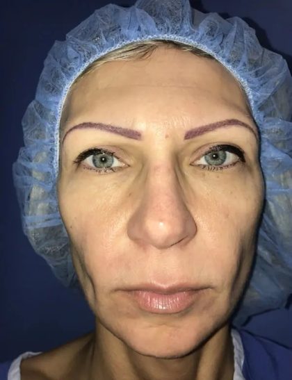 Facelift Before & After Patient #20949