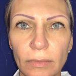 Facelift Before & After Patient #20949