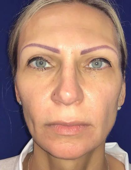 Facelift Before & After Patient #20949