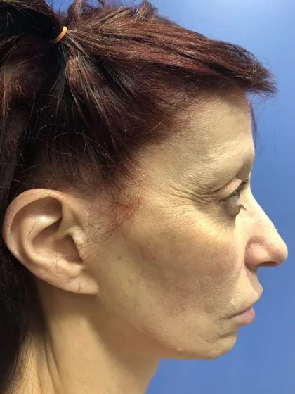 Facelift Before & After Patient #20992