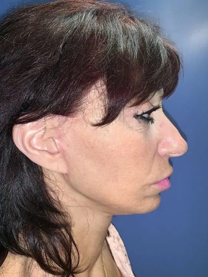 Facelift Before & After Patient #20992