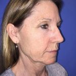 Facelift Before & After Patient #20993