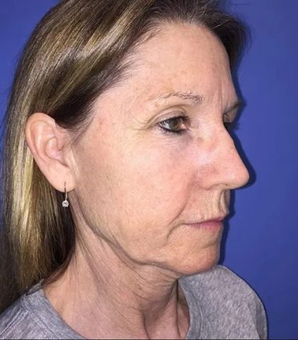 Facelift Before & After Patient #20993