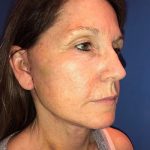 Facelift Before & After Patient #20993