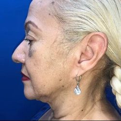 Facelift Before & After Patient #20994