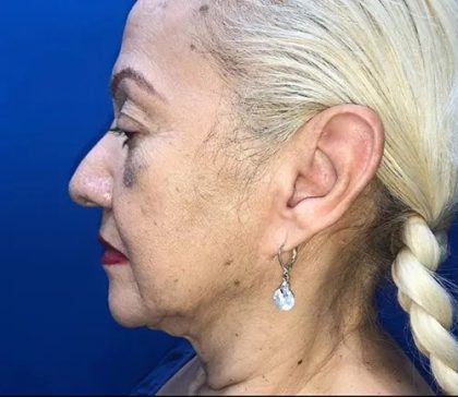 Facelift Before & After Patient #20994