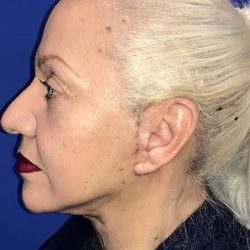 Facelift Before & After Patient #20994